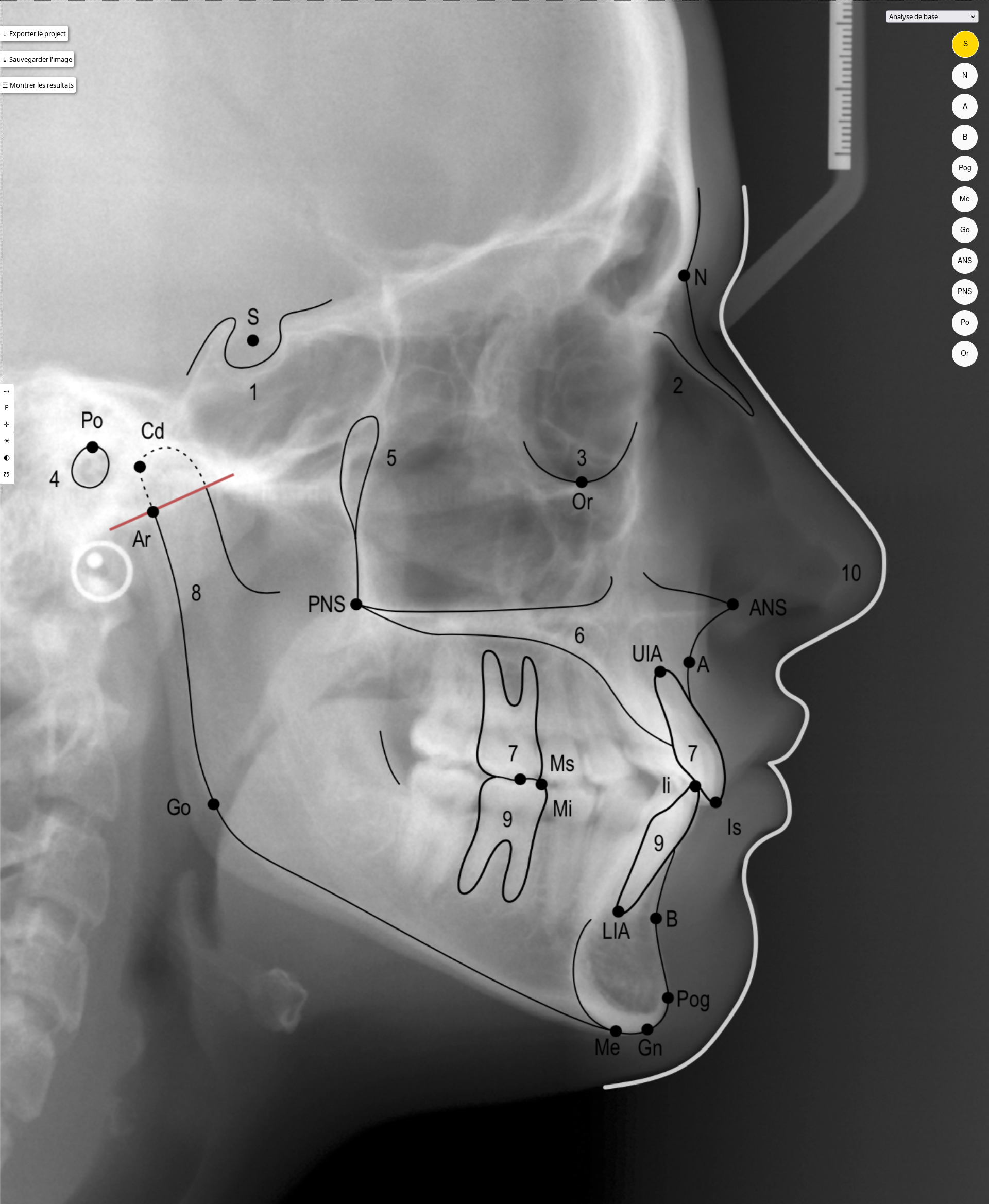 Analyse céphalométrique
